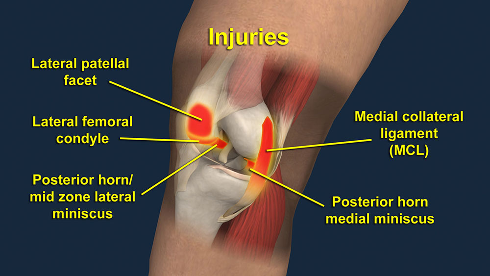 Knee Injury