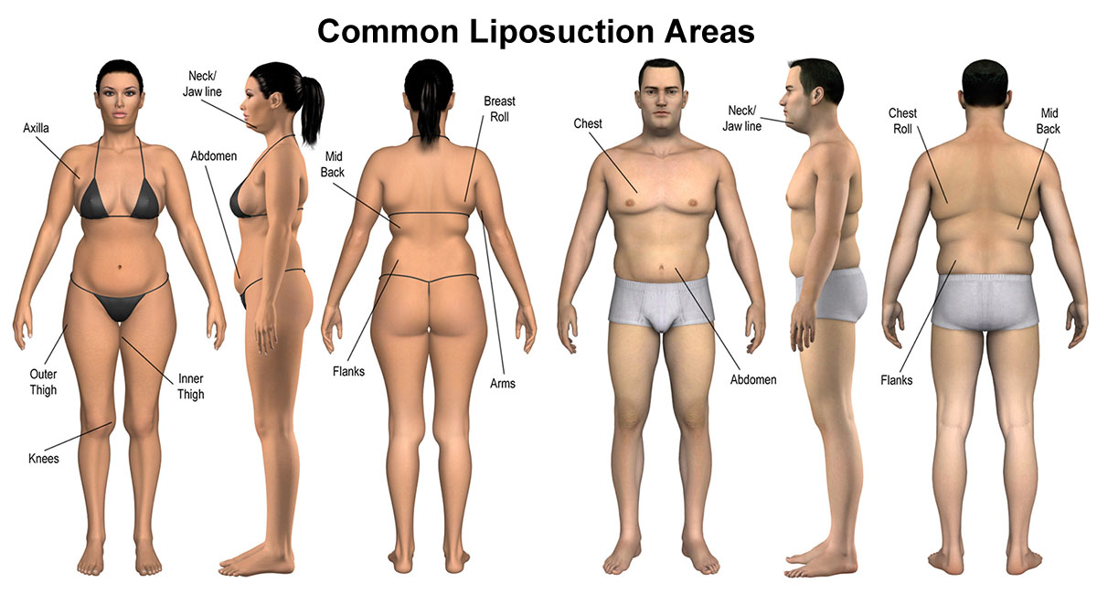 Liposuction