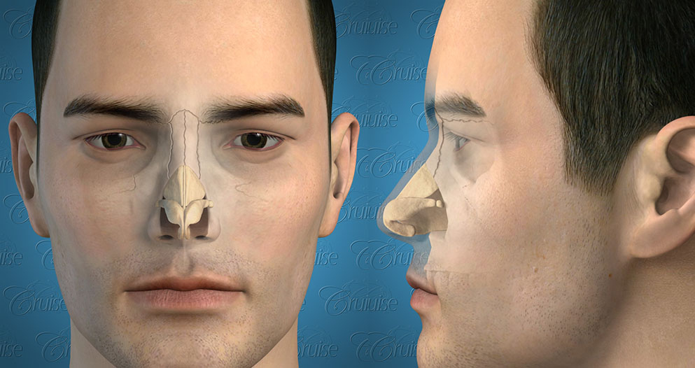 Можно вправить нос. Репозиция перегородки носа. Ринопластика анатомия. Репозиция костей носа восстановление.