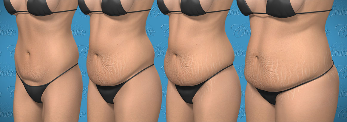 Tummy tuck variations