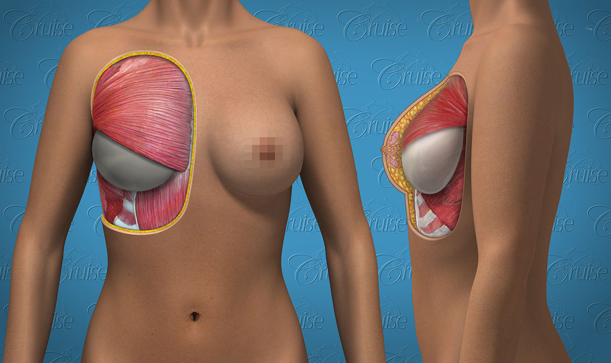 Under Muscle Implant